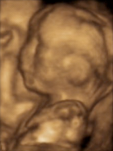 20-week-old foetus